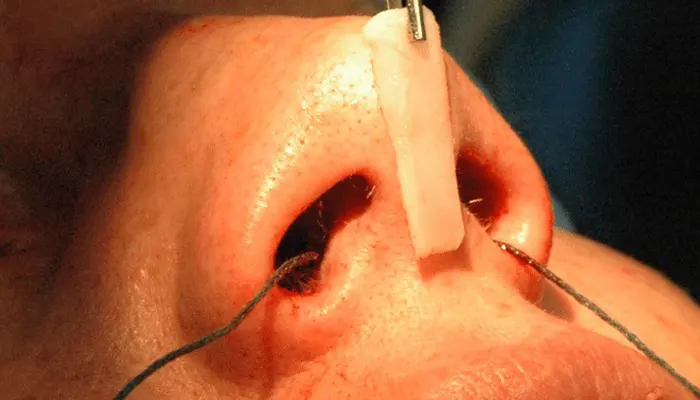 اهمیت کنترل آکنه پیش از جراحی بینی گوشتی