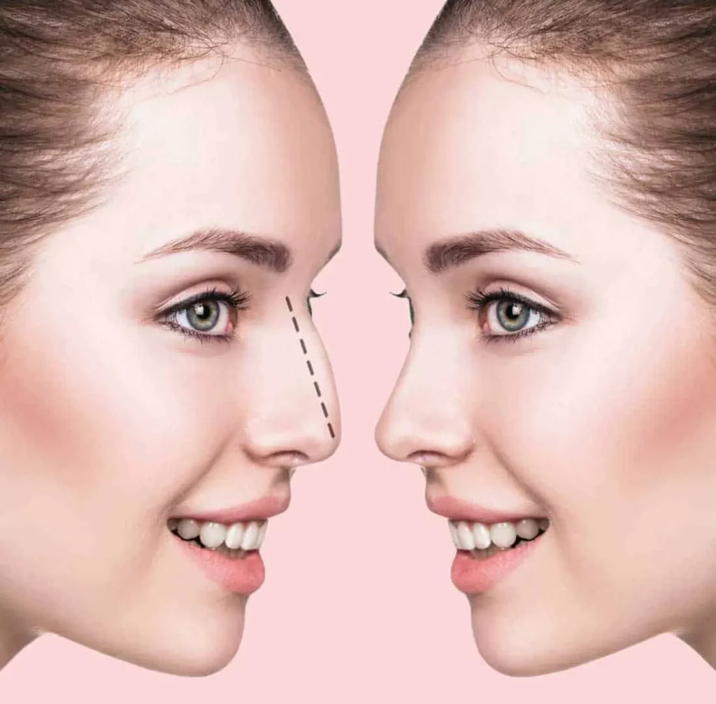 بهترین جراحی بینی در ایلام