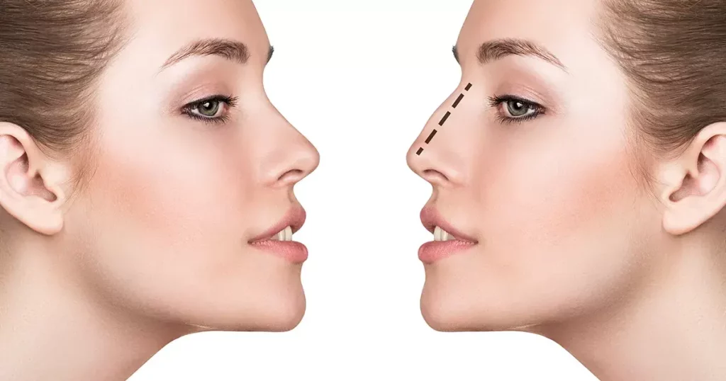 بهترین جراحی بینی در ایلام